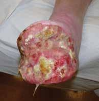 On his second assessment after surgery, the wound site appeared to be clinically infected. This resulted in a forefoot amputation.