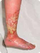 Eclypse Contour Super Absorbent Multisite Dressing An evaluation of Eclypse Contour in the management of highly exuding chronic venous leg ulcers Case 1: 63 year old male with