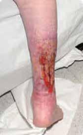 ulceration of right leg, on presentation ulceration highly exuding causing maceration around lateral malleolus and extension of would bed size.