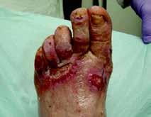 Activon Manuka Honey Tube Case 1: The use of Activon Tube on foot ulceration following a chemical burn injury on a patient with Diabetic Peripheral Sensory Neuropathy