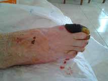 The shin has healed and the tip of her toes, the necrosis, has lifted