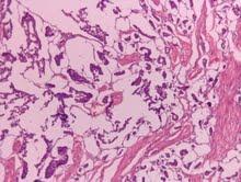 Figure 3:Specimen after whipples surgery. Postoperative course was uneventful and patient was discharged after 15 days. 2 years follow up Histopathology showed tumor invading was unremarkable.