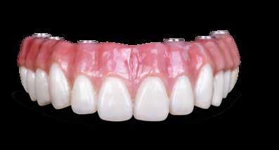Constructed from 100% BruxZir Solid Zirconia, this fully edentulous restoration offers exceptional resistance to chips, fractures and stains while improving chewing and speech function.