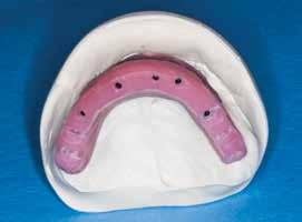 SECOND Jaw Relation Records and Shade Selection You will receive from Glidewell Laboratories a bite block with screw-retained temporary cylinders and a wax-rim checklist (Fig. 4).