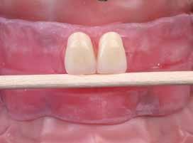 The study model of the patient s existing denture can be used as a reference regarding the size and shape of the new teeth. Select the shade and mold of the denture teeth; select the gingival shade.