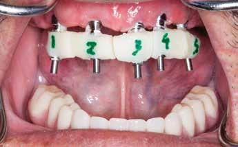 numbered on a working model. Each acrylic section contains a titanium cylinder. This procedure should be followed to ensure an accurate final impression. Remove the healing abutments or appliance.