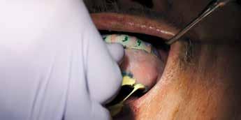 Note: The PMMA try-in appliance does not include tissue shade and glaze on the gingival areas of the prosthesis. Seat the PMMA try-in appliance on the multi-unit abutments.