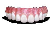 current denture for study casts Fabricate implant verification jig, custom tray, PMMA try-in appliance and provisional PMMA implant prosthesis (9 days) THIRD FOURTH Lute verification jig, take final