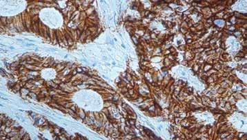 Isotype: Rabbit IgG Positive Control: Breast, Large Intestine, Breast Lobular Carcinoma Cellular Localization: Membrane/ Cytoplasmic Specificity: Cytoplasmic accumulation of p120 Catenin has been