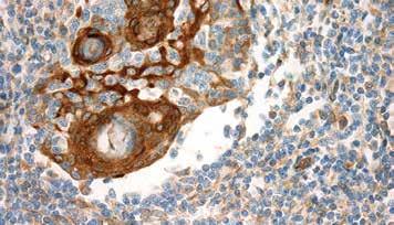 p40 and high molecular weight cytokeratin markers has been shown to be useful for distinguishing benign conditions mimicking cancer from prostate carcinomas.