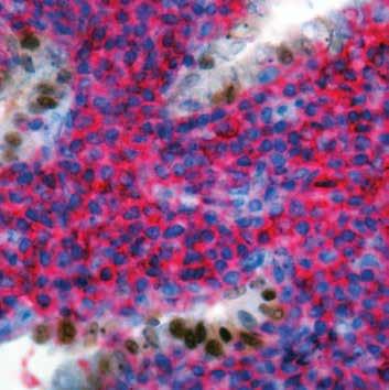 and Napsin A (brown) indicating Lung Adenocarcinoma. Image shows positive stain for CD45 (red) indicating Lymphoma. This kit aids in the differentiation of Primary Lung Adenocarcinoma from Lymphoma.