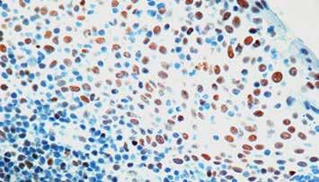 Renal Cell Carcinoma (gp200) Clone: PN-15 Catalog No.: Mob 465 Concentrated 1ml Mob 465-05 Concentrated 0.
