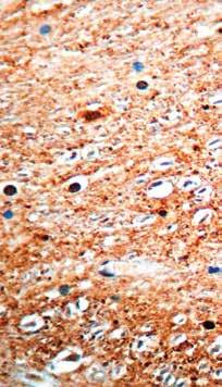 fibers in astrocytomas and Mallory bodies in alcoholic liver disease. It stains dot-like structures in the white matter of normal aging brain. Ubiquitin Catalog No.