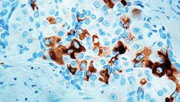 This antibody stains macrophages in human tissues and does not stain any other cell type. α-1-fetoprotein (AFP) Catalog No.: RP 001 Concentrated 1ml RP 001-05 Concentrated 0.
