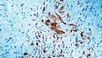 Immunogen: Recombinant full-length mouse calretinin protein. Isotype: IgG Positive Control: Mesothelioma Specificity: This antibody recognizes a 31.5 kda protein named calretinin.