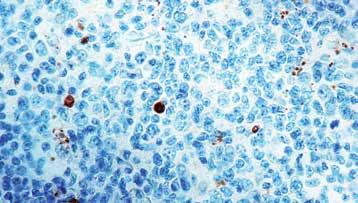 ) Formalin fixed paraffin embedded human tonsil stained with Caspase 3 antibody (Mob 309). Immunogen: BALB/C mice were injected with recombinant full length human caspase 3 protein.