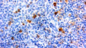 5ml RMPD 013 Prediluted 6ml RMPD013-10RM Prediluted 10ml Formalin fixed paraffin embedded human tonsil stained with CD23, B Cell antibody(mob 152). Immunogen: EBV-transformed B lymphoblastoid cells.