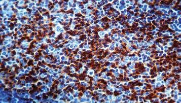 Rare cases of undifferentiated and neuroendocrine carcinomas with CD45 positive staining have been reported. CD45/Leukocyte Common Antigen (LCA) Clone: PD7/26 + 2B11 Catalog No.