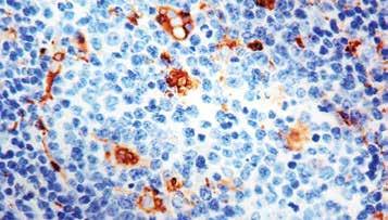 : Mob 301 Concentrated 1ml Mob 301-05 Concentrated 0.5ml Formalin fixed paraffin embedded human melanoma stained with CD63 antibody (Mob 301). Immunogen: Smooth plasma membrane fraction of MeWo cells.