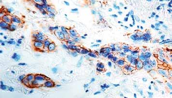 ) Formalin fixed paraffin embedded colon carcinoma stained with Cdx2 antibody (RMAB 059). Immunogen: A synthetic peptide corresponding to residues near the C-term of human Cdx2 protein.