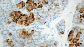 This antibody stains a variety of neuroendocrine tumors. Chromogranin A Catalog No.: RP 008 Concentrated 1ml RP 008-05 Concentrated 0.