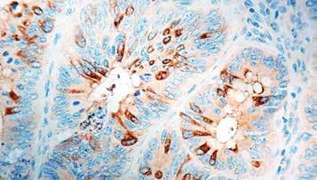 5ml PDM 145 Prediluted 6ml Formalin fixed paraffin embedded human breast carcinoma stained with Cyclin E antibody (Mob 266). Immunogen: Synthetic peptide corresponding to human cyclin E protein.