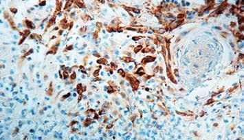 Positive Control: Lung and colon carcinoma, membrane Specificity: This antibody reacts with a 70 kda protein. COX-2 (Cyclooxygenase-2) is an inducible enzyme.