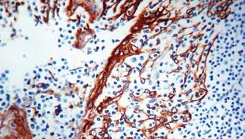 : Mob 092 Concentrated 1ml PDM 043 Prediluted 6ml /E Formalin fixed paraffin embedded human prostate carcinoma stained with Cytokeratin AE3 antibody (Mob 093).