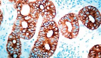 Cytokeratin 6 and 16 are expressed in keratinocytes undergoing hyper proliferation. Cytokeratin is found in hair follicles, suprabasal cells of a variety of internal stratified epithelia.