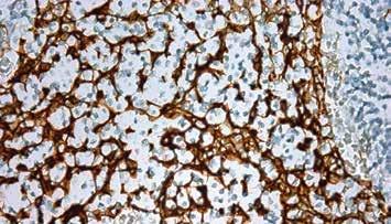 Cytokeratin 16 is expressed in keratinocytes, which are undergoing rapid turnover in the suprabasal region.