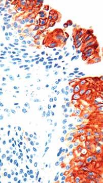 5ml Formalin fixed paraffin embedded human colon stained with Cytokeratin 20 antibody (RMAB 060). Immunogen: A synthetic peptide corresponding to residues near the C-terminus of human CK20 protein.