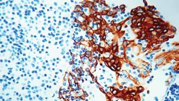 Studies have shown that a marked difference exists in the expression of Cytokeratin 20 among various carcinomas. Cytokeratin, High Molecular Weight Clone: 34βE12 Catalog No.