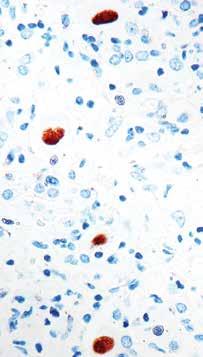 5ml PDM 006 Prediluted 6ml PDM006-10MM Prediluted 10ml Formalin fixed paraffin embedded human skin stained with Cytokeratin Wide Spectrum antibody (PDR 035).