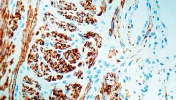 ) Formalin fixed paraffin embedded human leiomyoma stained with Desmin antibody (PDM 006). Immunogen: BALB/C mice were immunized with purified desmin from human muscle.