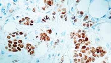 ) Formalin fixed paraffin embedded human breast carcinoma stained with Estrogen Receptor antibody (Mob 121).