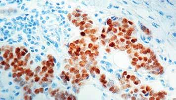 Positive Control: Breast carcinoma Specificity: This antibody is specific to estrogen receptor, which is associated with superior prognosis and a better response to anti-estrogen therapy.