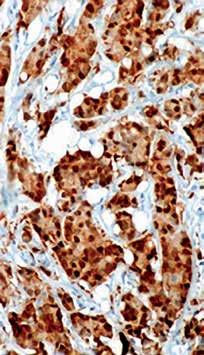 Positive Control: Breast carcinoma Specificity: This antibody is specific to 60 kda protein, HSP60. HPS60 is a potential antigen in a number of autoimmune diseases including human arthritis.