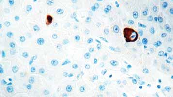 ) Formalin fixed paraffin embedded liver stained with Hepatocyte Specific Antigen antibody (Mob 426). Immunogen: Human liver fixed in formalin.