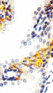 ) Formalin fixed paraffin embedded breast carcinoma stained with HER2/neu antibody (RMAB 026). Immunogen: A synthetic cyclic peptide from the antigen C-terminus.