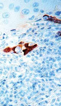 ) Formalin fixed paraffin embedded HSVII stained with HSV1&2 antibody (RP 162).