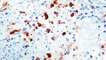 : PDM 081 Prediluted 6ml (Only for markets outside the U.S. For U.S. market, see index III.) Formalin fixed paraffin embedded tissue stained with HSV I,II antibody (PDR 034).