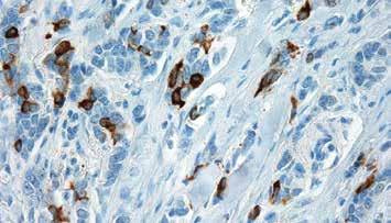 5ml RMPD 036 Prediluted 6ml NEW Formalin fixed paraffin embedded human melanoma stained with Mart-1 Antibody (RMAB 044).