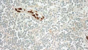 5ml PDM 011 Prediluted 6ml PDM011-10MM Prediluted 10ml Formalin fixed paraffin embedded human tonsil stained with Mast Cell Chymase antibody (Mob 346).