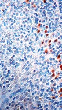 Immunogen: Pigmented melanoma metastases from lymph nodes (HMB45). Recombinant human MART-1 protein (A103). Recombinant tyrosinase protein T311.