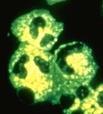 Methods of ANCA Testing Indirect Immunofluorescence canca panca Load Antigen Add Serum Antibody Add Antibody Enzyme