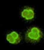 canca GPA (Wegener s) Microscopic polyangiitis EGPA (Churg-Strauss) Case reports of associations positive canca by IIF positive