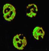 antigen-specific (PR3, MPO) ELISA panca GPA (Wegener s) Microscopic polyangiitis EGPA (Churg-Strauss) Idiopathic crescentic GN