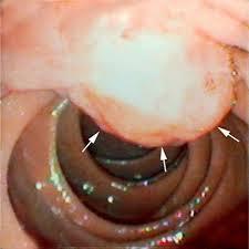 Parts of CBD: o First part is found in the free edge of the lesser omentum.