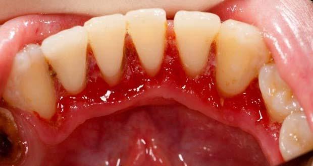 Common Perinatal Oral Health