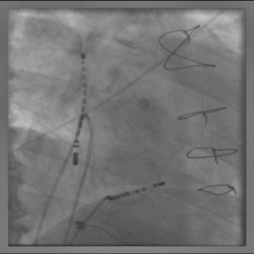Group I 33 pts with Persistent AF who converted to AT during ablation of AF CS and